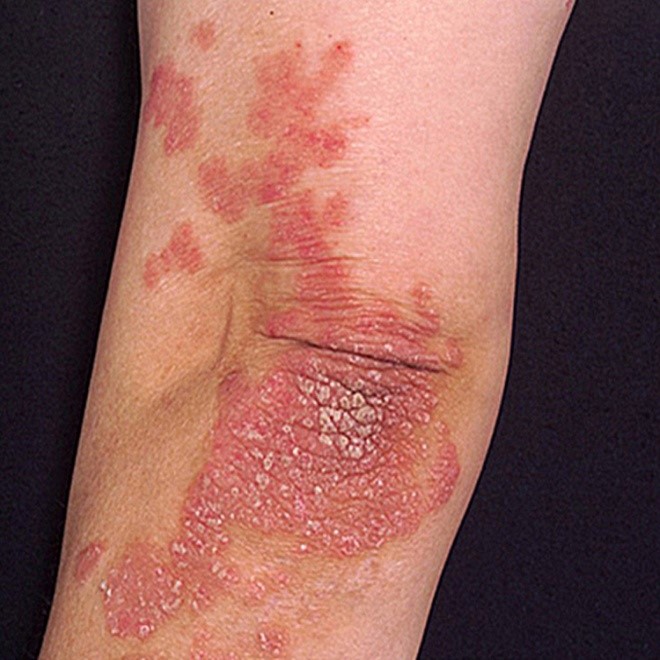 What Is Psoriasis Marathi Pathology Of Psoriasis What Is Psoriasis 