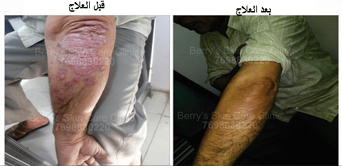 Plaque psoriasis Treatment