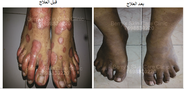 Diagnosis of Psoriasis