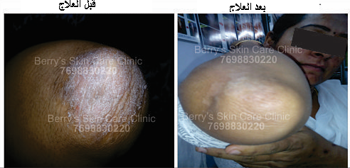 Treatment of Plaque psoriasis