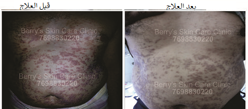 Chest Psoriasis