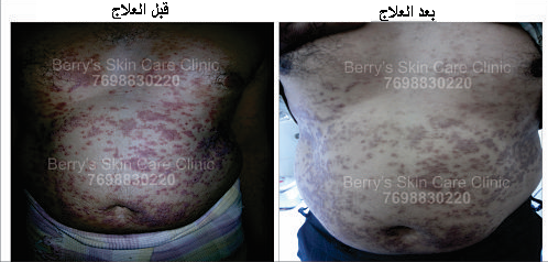 Guttate Psoriasis Treatment