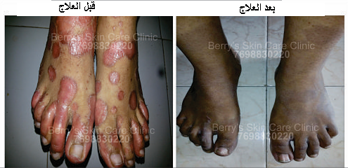 Psoriasis on Palm and Sole