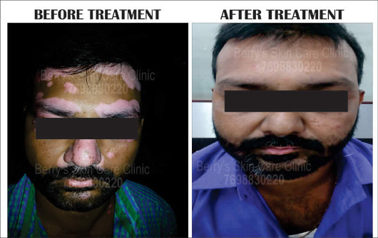 Result of Leucoderma Treatment