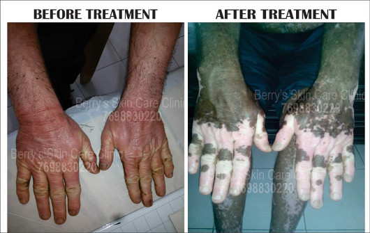 Result of Leucoderma Treatment