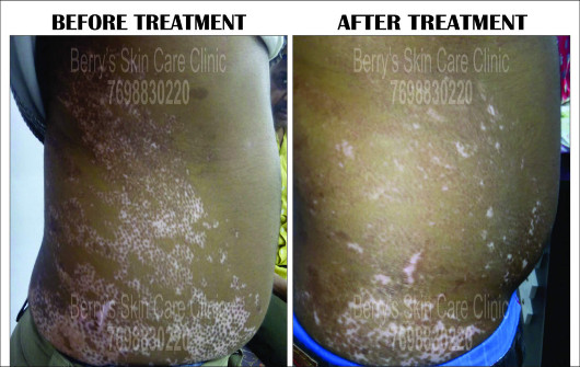 Result of Leucoderma Treatment