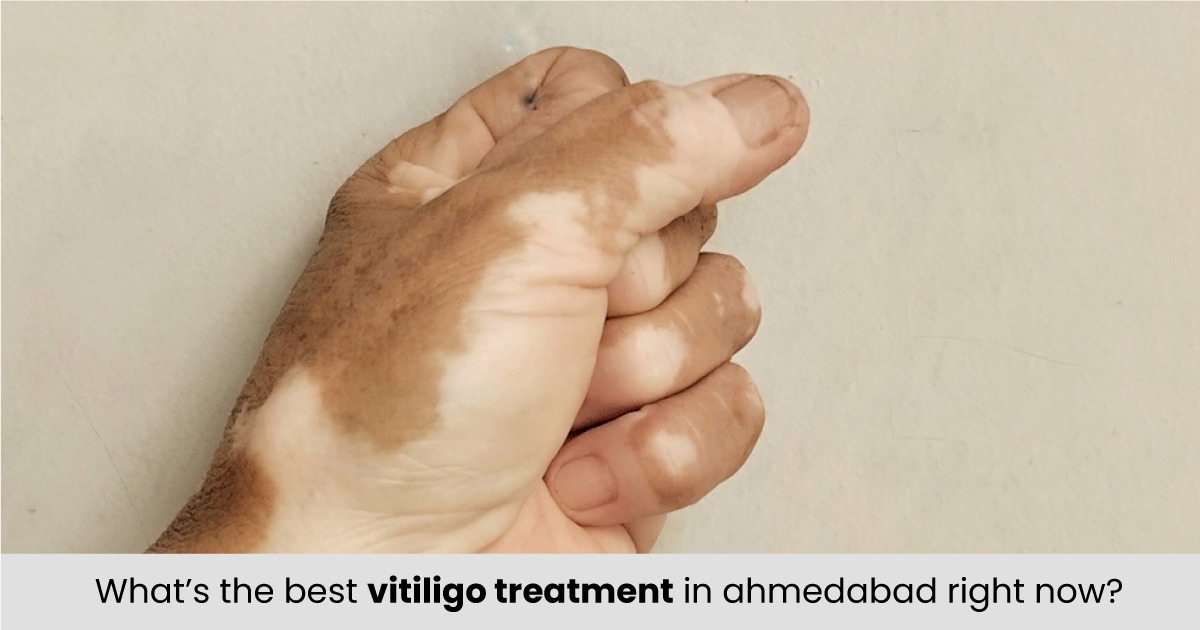 What’s the Best Vitiligo Treatment in Ahmedabad Right Now?